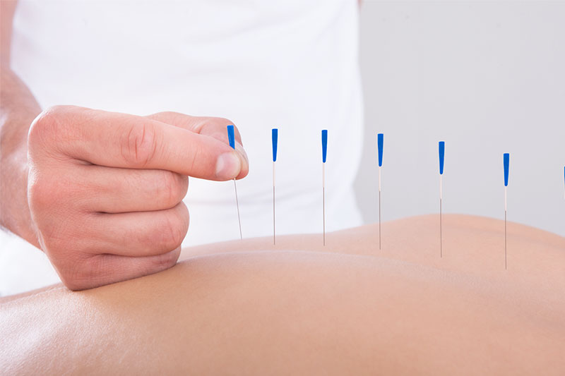Acupuntura