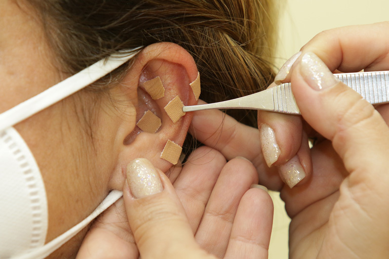 Auriculoterapia
