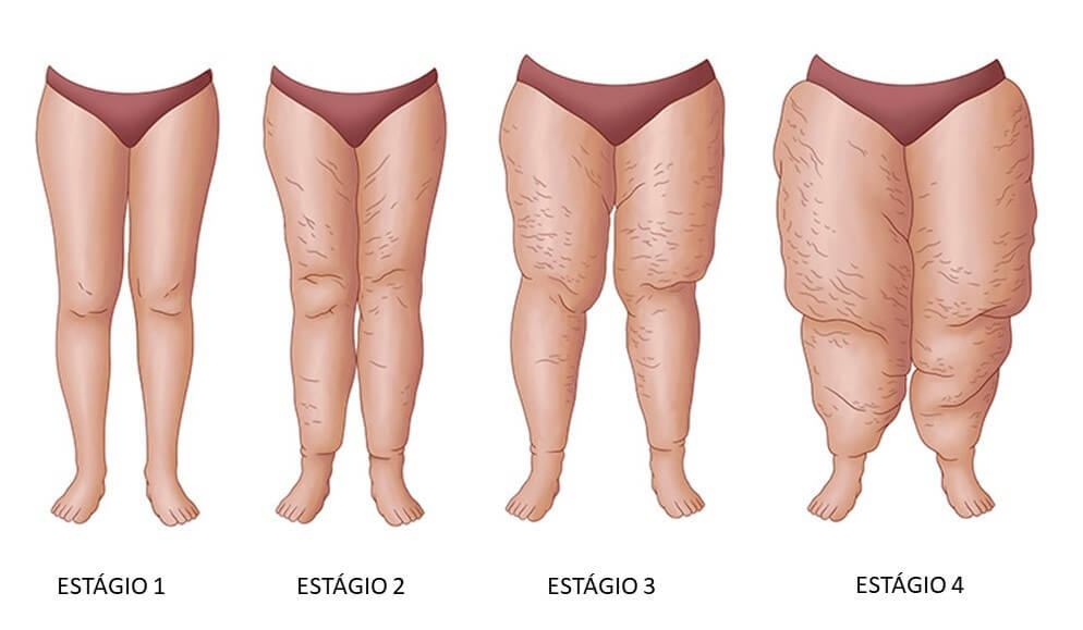 Lipedema